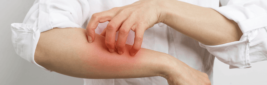 Person kratzt sich am geröteten Unterarm, Nahaufnahme von Hautirritation mit sichtbarer Rötung auf hellem Hintergrund